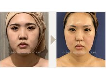 【12か月の結果】劇的小顔フェイシャル