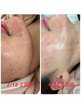 セラピア(Serapia)/水光ピーリング