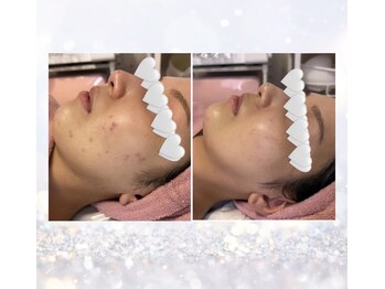 ベルメール(Bellemer)/肌質改善