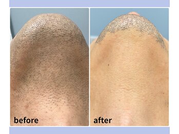 ベルミーランド 浜松天王/脱毛Before→After