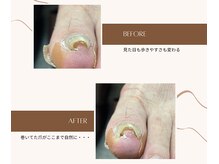 町田市巻き爪センターの雰囲気（独自の技法により分厚い巻き爪にも対応）