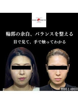 オアシス トウキョウ 川崎店(OASIS TOKYO)/サボテン美容鍼×美作矯正