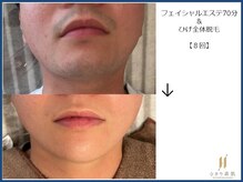 ひかり素肌/おひげ脱毛とフェイシャルエステ