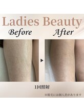 シャーロック(4869Sherlock)/脚BeforeAfter