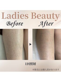 シャーロック(4869Sherlock)/脚BeforeAfter