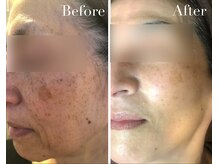 アブニールブリヨン/2BBioハーブピーリング/肌質改善