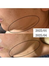 サロン ド エン(Salon de. en)/たるみケア◇ハーブピーリング