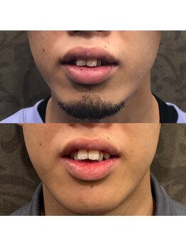 フェリーバ 流山店(FELIVA)/ツルツルスッキリ(^^)