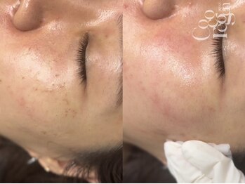 サゥオルサロン(sawalsalon)の写真/【神戸初上陸*韓国発Cocoregen】レーザー・麻酔不使用なので痛みが少ない施術!シミ集中ケア+肌の透明感UP◎