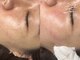 サゥオルサロン(sawalsalon)の写真/【神戸初上陸*韓国発Cocoregen】レーザー・麻酔不使用なので痛みが少ない施術!シミ集中ケア+肌の透明感UP◎
