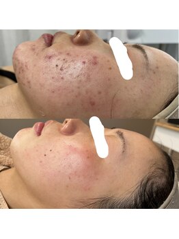 コットンビューティ(cotton.beauty)/ニキビ改善