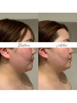 マヌレニ(manuleni)/高周波で痛みなく引き締める