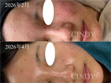 シンディー(CINDY)の雰囲気（研磨剤不使用で肌に優しく奥まで届ける韓国最新ハーブピーリング）