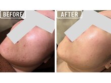 毛穴屋の雰囲気（回数を重ねることで肌質改善へ導きます◎）