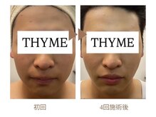 タイム(THYME)の雰囲気(レモンボトルでフェイスラインのもたつき二重顎ケア)