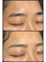 セレニティ(Serenity)/お顔のワックス脱毛