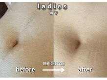 キュー(cue)/【レディース】「胸下脱毛」