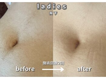 キュー(cue)/【レディース】「胸下脱毛」