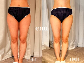 エヌ 白金台(enu)/頑固な脂肪にアプローチ