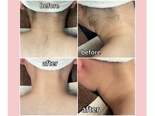 ベルミーランド 浜松天王/脱毛Before→After