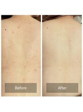 ビビ(VIVI)/背中ケアにハーブピーリング