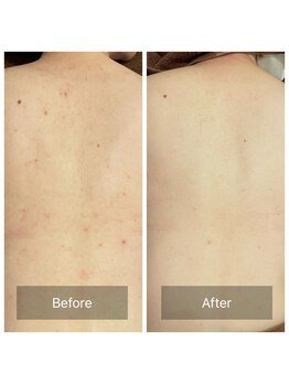 ビビ(VIVI)/背中ケアにハーブピーリング