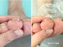 コバコ(kobaco)/巻き爪ケア　２回目　人差し指