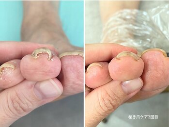 コバコ(kobaco)/巻き爪ケア　２回目　人差し指