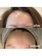 オプレア 千種店(OPREA)/【比較写真】ハーブピーリング