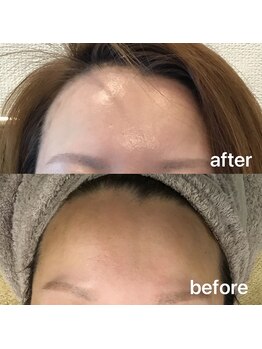 オプレア 千種店(OPREA)/【比較写真】ハーブピーリング