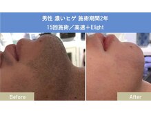 ソテ ボー(Sauter beau)/男性濃いヒゲ 15回施術