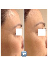 レーヴリゼ(Revelise)/ララピール＋ララピールパック