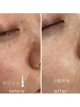 アネラ キキ サロン(anela kiki salon)/美肌肌質改善VOSサロンケア