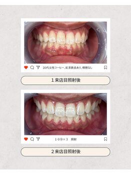 スマイルプライベートビューティサロン(Smile)/セルフホワイトニング