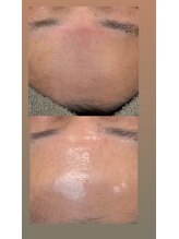 フットミー(foot mii)/フェイシャル１回目比較