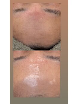 フットミー(foot mii)/フェイシャル１回目比較