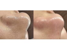 ルミナエステ(LUMINA ESTH)/毛穴／毛穴洗浄／毛穴ケア｜症例