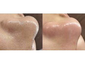 ルミナエステ(LUMINA ESTH)/毛穴/毛穴洗浄/毛穴ケア|症例