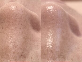 サロン ド ミュゲの写真/【毛穴美人誕生♪】クレンジング洗顔→ピーリング→毛穴洗浄→美容液導入→パックがセットになって6980円♪