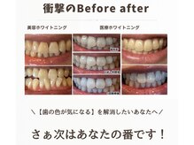 ホワイトニング ビューティー 南魚沼店(whitening beauty)の雰囲気（結果重視！口元気にせず輝く笑顔に）