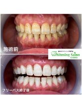 ホワイトニングサロン 名古屋駅店/【ホワイトニング施術例】