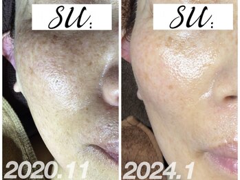スー(su:)/シミくすみにもアプローチ！