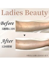 シャーロック(4869Sherlock)/脚BeforeAfter