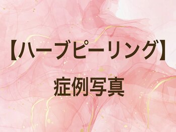 スイ 昭島店(Sui)/ハーブピーリング/症例写真