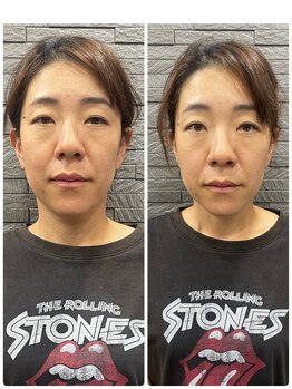 長寿鍼灸院 長寿整骨院/美容鍼50本の効果★ハリ・ツヤ