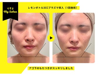 イエス マイサロン(yes My Salon)/レモンボトル施術例