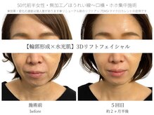 サボラミ(sabor A Mi)/ほうれい線・口横ポニョに変化☆