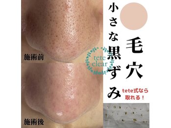 ティアラ(TIARA)/tete式毛穴エクストラクション
