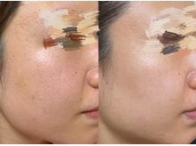 エトワール 駒沢大学駅前店(ETOILE)/肌質・たるみ改善|ほうれい線