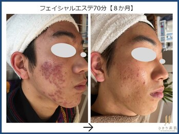 ひかり素肌/フェイシャルエステ 8か月